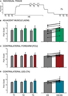 Modulation of Muscle Pain Is Not Somatotopically Restricted: An Experimental Model Using Concurrent Hypertonic-Normal Saline Infusions in Humans